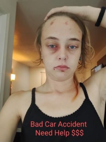 I was in a car Accident so i don't look normal - 1