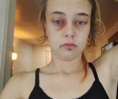 Atlanta escorts - I was in a car Accident so i don't look normal