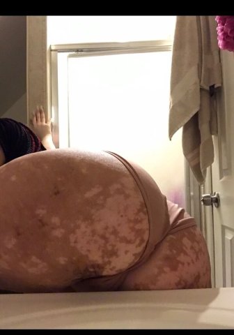 Long Island Vitiligo Babe Incalls & CarPlay - 1